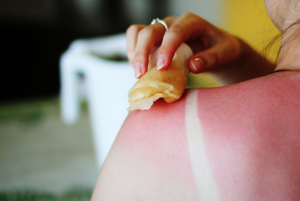 Frau kühlt ihren Sonnenbrand an der Schulter