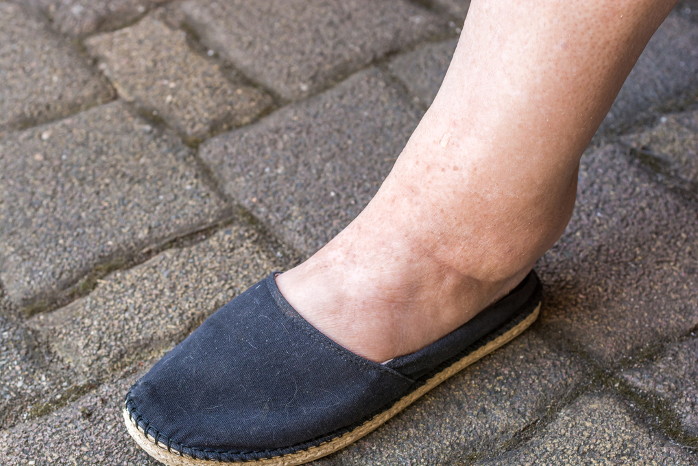 Pieds enflés chaussés d'espadrilles